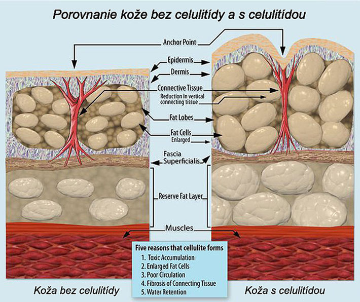 Celulitida prejavz na koži